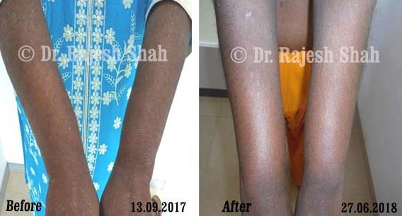 Psoriasis Before and After Case Photo