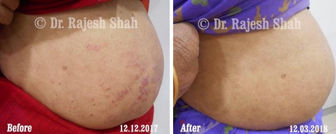 Psoriasis Before and After Case Photo