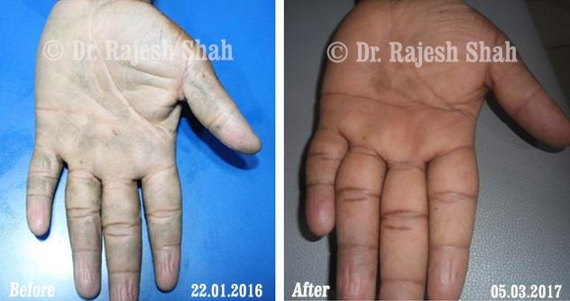 Psoriasis Before and After Case Photo