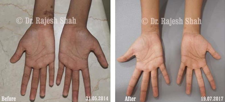 Lichen Planus Before and After Case Photo