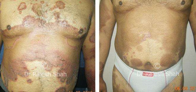Psoriasis Before and After Case Photo