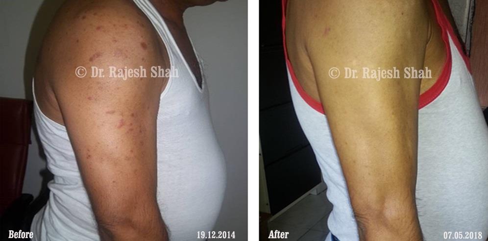 Psoriasis Before and After Case Photo