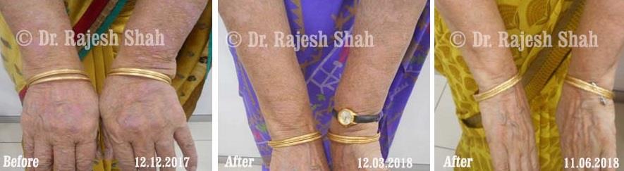 Psoriasis Before and After Case Photo