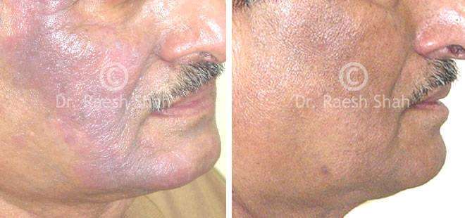 Eczema Before and After Case Photo