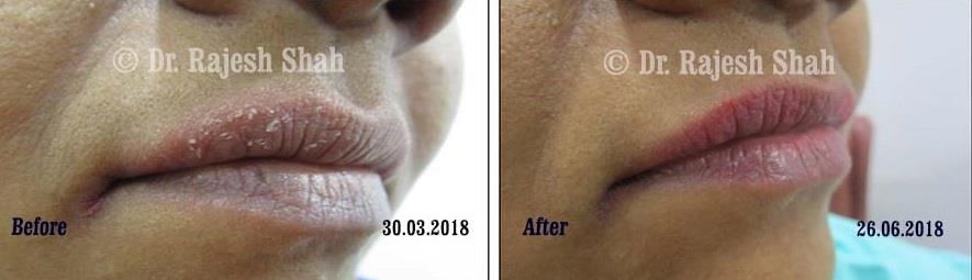 Cheilitis Before and After Case Photo