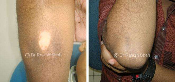 Vitiligo Before and After Case Photo