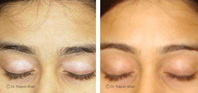 Vitiligo Before and After Case Photo