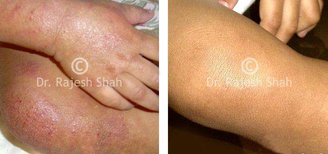Eczema Before and After Case Photo