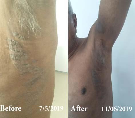 Eczema Before and After Case Photo