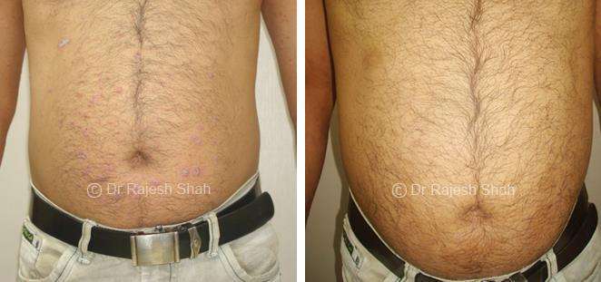 Psoriasis Before and After Case Photo