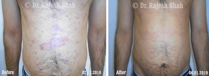 Psoriasis Before and After Case Photo