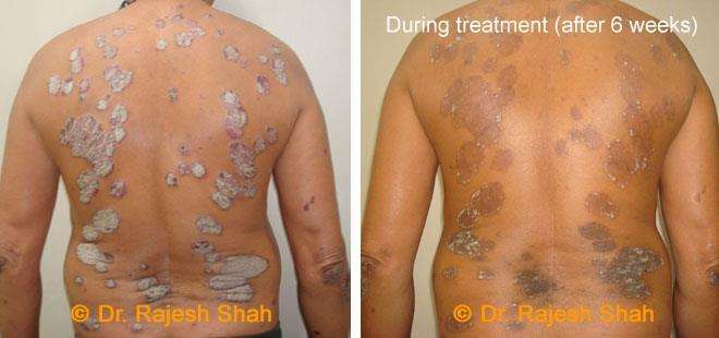 Psoriasis Before and After Case Photo