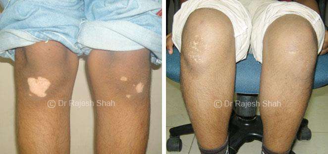 Vitiligo Before and After Case Photo