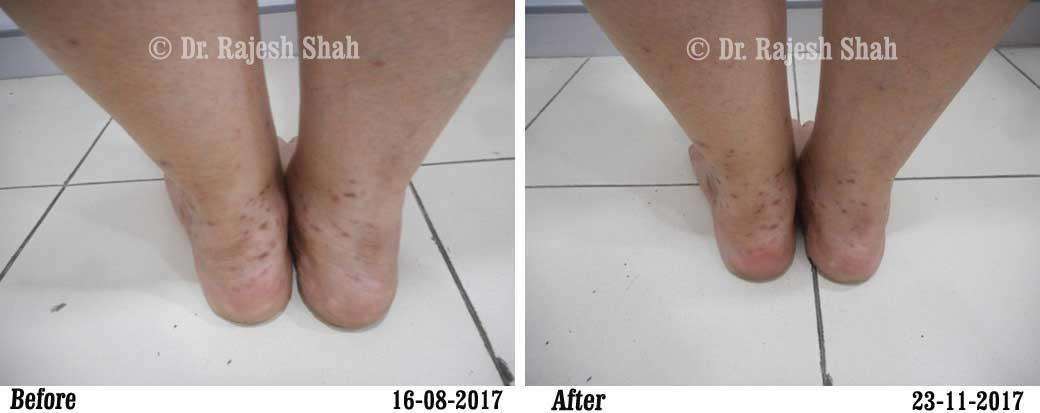 Lichen Planus Before and After Case Photo