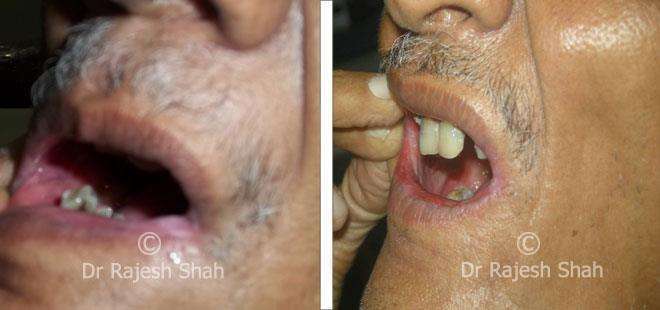 Lichen Planus Before and After Case Photo