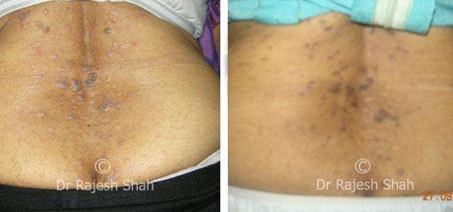 Lichen Planus Before and After Case Photo
