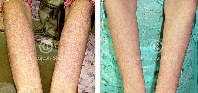 Lichen Planus Before and After Case Photo