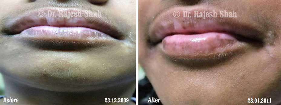 Vitiligo Before and After Case Photo