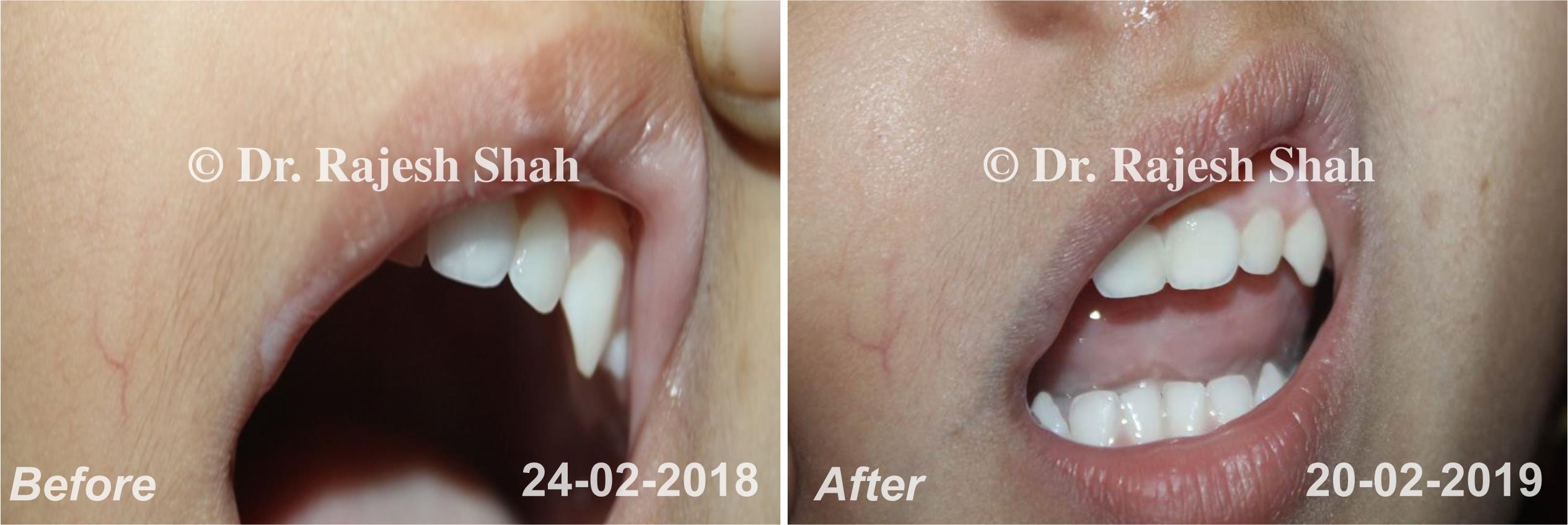 ulcer Before and After Case Photo