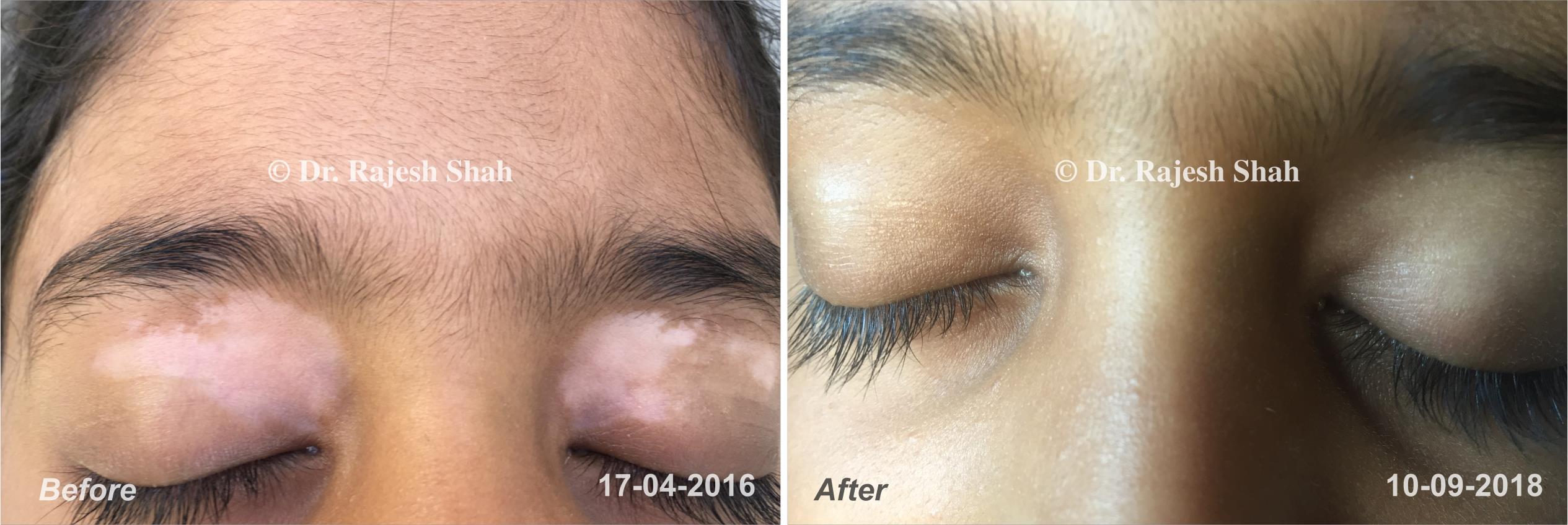 Vitiligo Before and After Case Photo