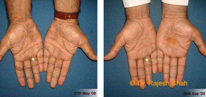 Psoriasis Before and After Case Photo