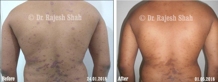 Psoriasis Before and After Case Photo