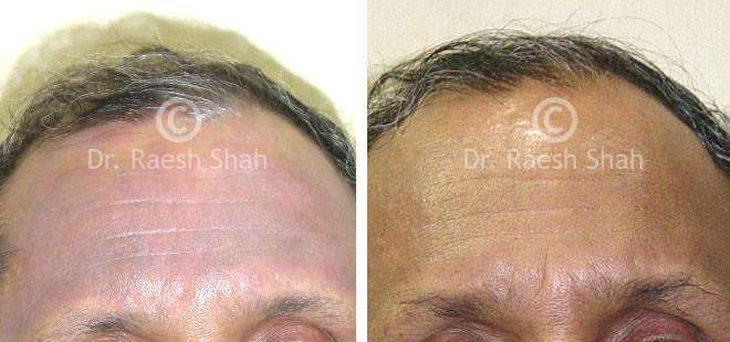 Eczema Before and After Case Photo