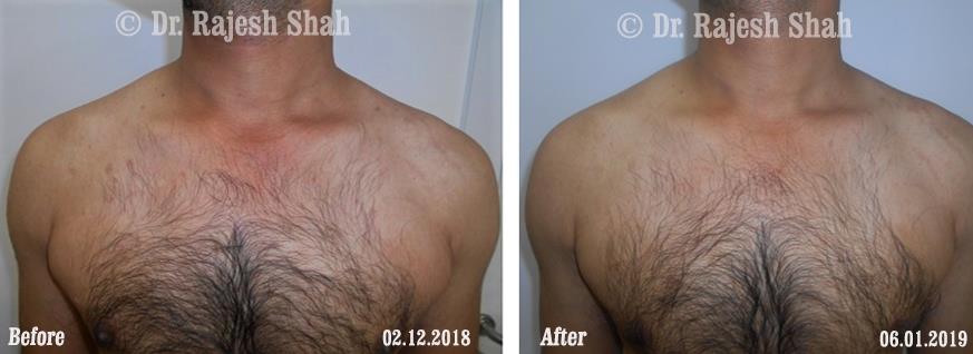 Psoriasis Before and After Case Photo