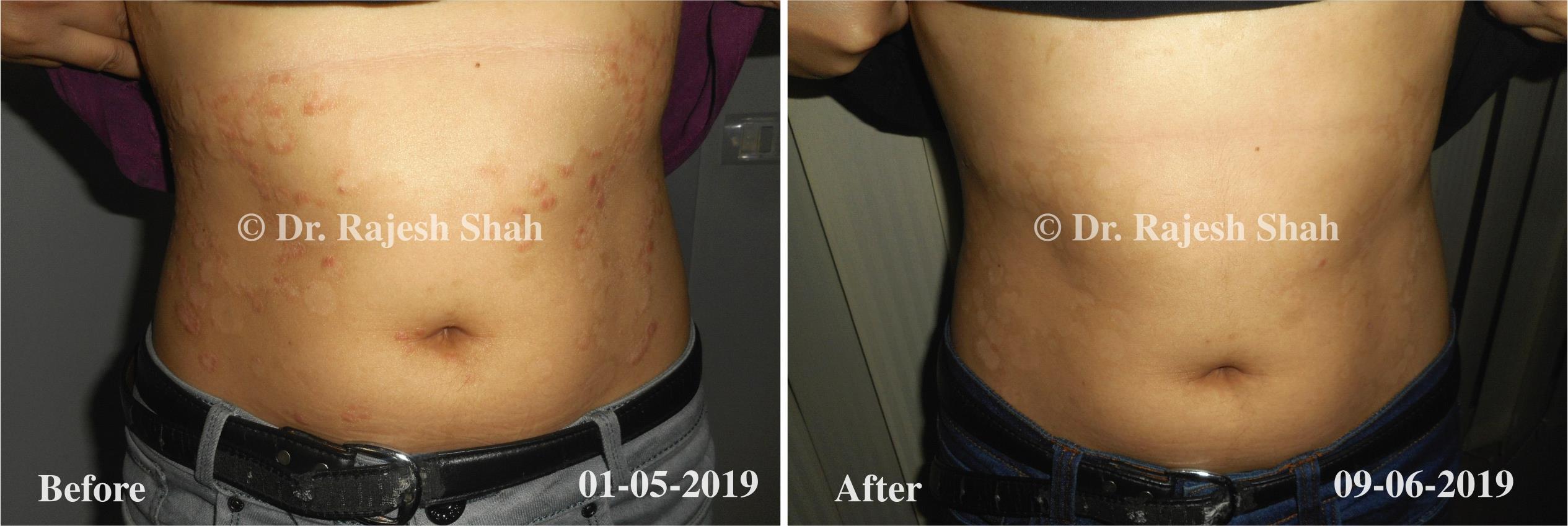 Psoriasis Before and After Case Photo