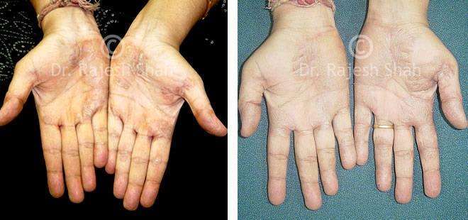 Eczema Before and After Case Photo