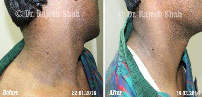 Psoriasis Before and After Case Photo