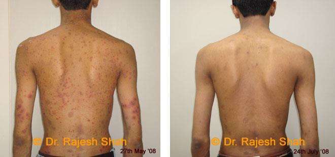 Psoriasis Before and After Case Photo