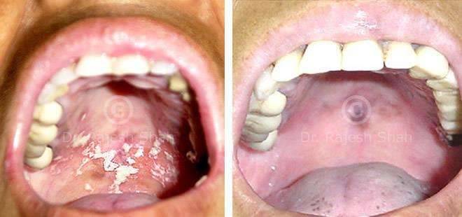 Lichen Planus Before and After Case Photo