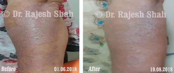 Psoriasis Before and After Case Photo
