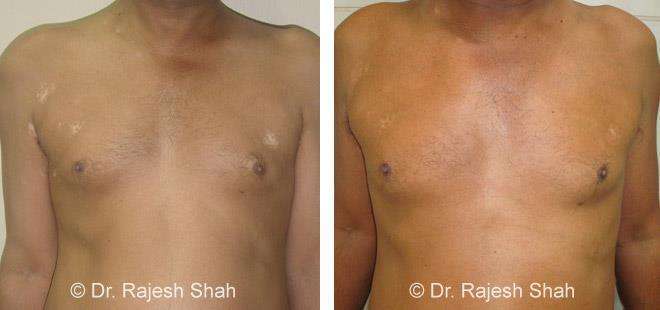 Vitiligo Before and After Case Photo