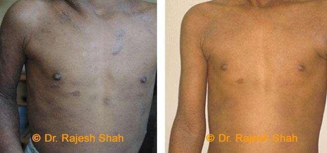 Eczema Before and After Case Photo