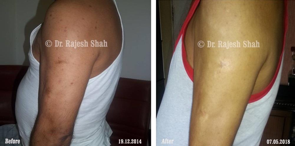 Psoriasis Before and After Case Photo