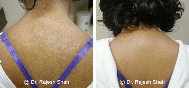 Psoriasis Before and After Case Photo