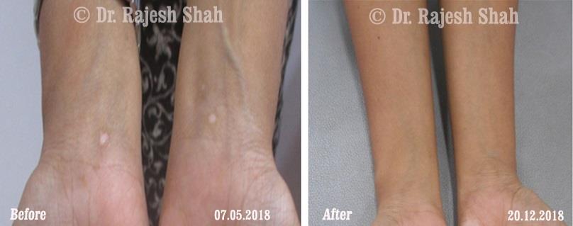 Vitiligo Before and After Case Photo