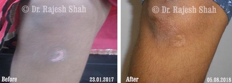Vitiligo Before and After Case Photo