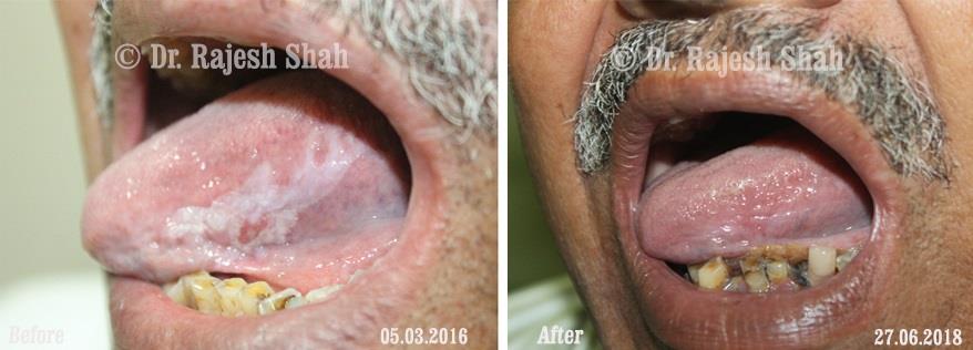 Lichen Planus Before and After Case Photo