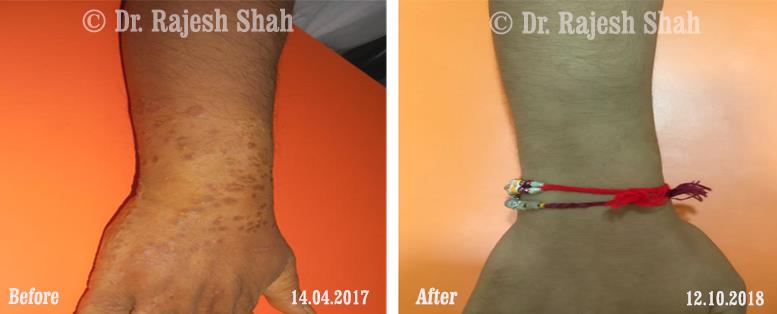 Psoriasis Before and After Case Photo