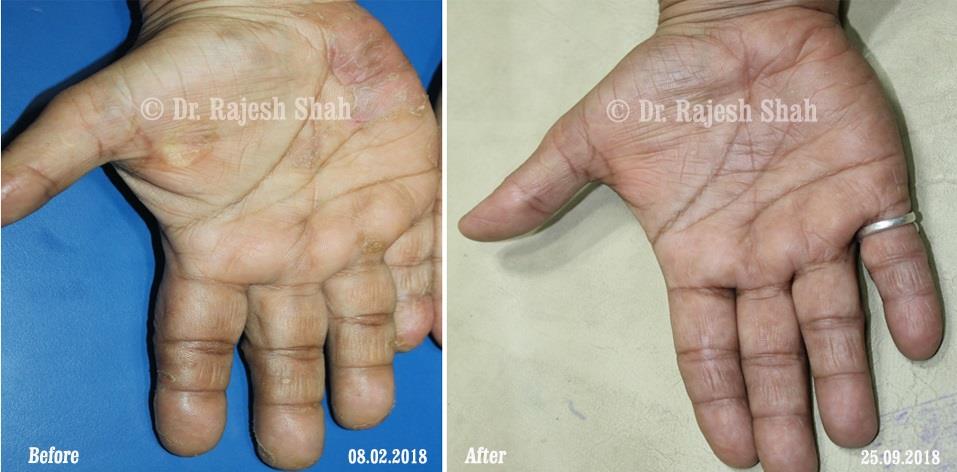 Psoriasis Before and After Case Photo