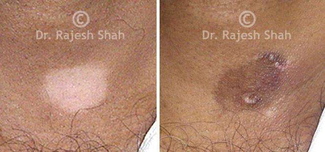 Vitiligo Before and After Case Photo