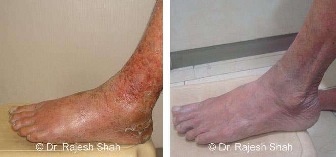 Psoriasis Before and After Case Photo