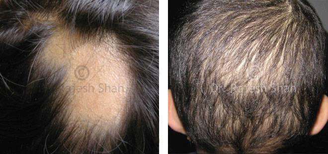 Alopecia Areata Before and After Case Photo