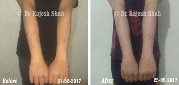 Lichen Planus Before and After Case Photo