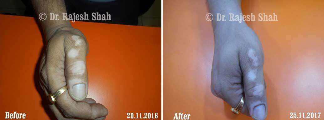 Vitiligo Before and After Case Photo