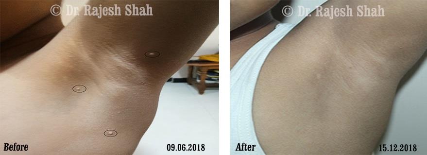 Molluscum contagiosum Before and After Case Photo