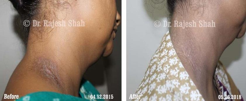 Prurigo Nodularis Before and After Case Photo
